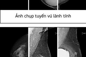  Chuyên gia AI  Viettel giành giải nhất với giải pháp phát hiện ung thư tuyến vú