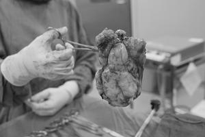 Bệnh nhân 26 tuổi ung thư buồng trứng trên nền hội chứng Turner thể khảm 