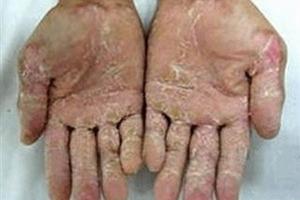 Phòng chống hội chứng viêm da dày sừng bàn tay,  bàn chân