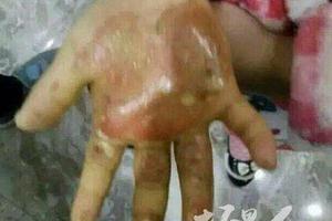 Mẹ đẻ nhúng tay con gái vào nước sôi, rắc muối vào vết thương