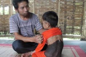 Cháu bé 5 tuổi mọc lông như “người rừng”