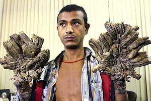 "Người cây" Bangladesh bước đầu phẫu thuật cắt bỏ 5kg "vỏ"