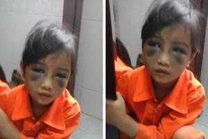 Bé lớp 1 bị cô giáo đánh tím mặt vì viết sai chính tả