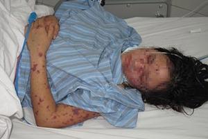 Hà Nội ghi nhận ca nhiễm viêm não mô cầu nguy hiểm đầu tiên