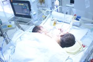 Cặp song sinh dính liền tử vong trên đường về Hà Giang