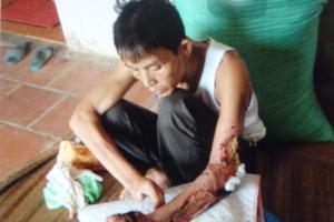 “Thần y” chữa rắn độc cắn