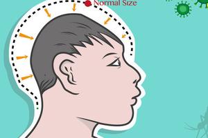 Trường hợp đầu tiên mắc chứng đầu nhỏ liên quan tới virus Zika 