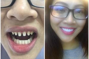 Hoa khôi Diệu Ngọc - Đại diện người đẹp Việt ở Hoa hậu Thế giới bị tố phẫu thuật thẩm mỹ