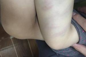 Bé 2 tuổi bị cô giáo mầm non đánh bầm hai đùi