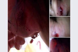 Thực hư chuyện cô giáo “quệt tay” bé 4 tuổi chảy máu tai