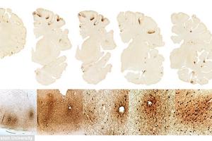 Phát hiện loại protein hỗ trợ chẩn đoán bệnh gây hại não mãn tính