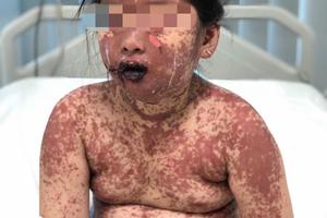 Dùng thuốc ở phòng khám tư, cháu bé 7 tuổi bị bỏng toàn thân