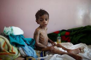 Nạn đói ở Yemen: Khủng hoảng nhân đạo nghiêm trọng nhất thế giới