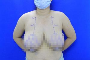 Người phụ nữ ngã dúi mặt vì ngực lớn gấp 6 lần bình thường