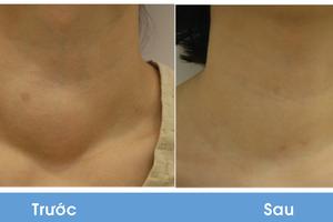 Nhẹ nhàng loại bỏ u tuyến giáp, không cần mổ 