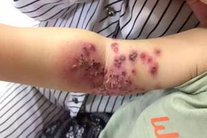 Bé 18 tháng tuổi sưng rộp, lở loét cánh tay vì nụ hôn của mẹ