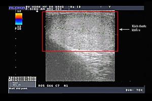 Phẫu thuật thành công cho bệnh nhân có 3 tinh hoàn hiếm gặp