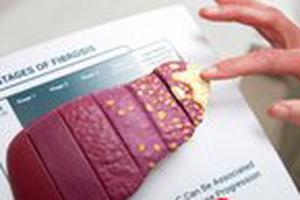 5 nguyên nhân khiến người Việt mắc và chết vì ung thư gan cao thứ 4 thế giới