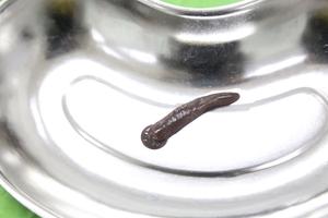 Phú Thọ: Gắp con đỉa dài 10cm sống trong cổ họng một bệnh nhân