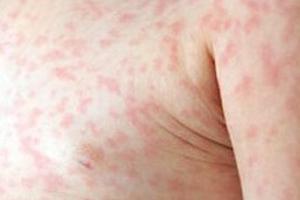 56 tỉnh/thành phố có bệnh sởi