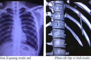 Chiếc đinh tự động rơi xuống khoang màng phổi thanh niên 18 tuổi