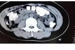 Phát hiện hàng trăm hạt trân châu chưa tiêu hóa trong bụng một cô bé