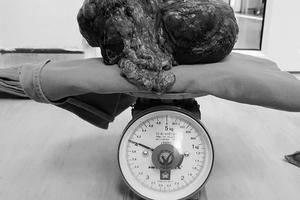 Bệnh viện K: Phẫu thuật thành công loại bỏ u mạc treo ruột khổng lồ hiếm gặp