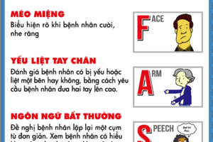 Sử dụng trí tuệ nhân tạo trong điều trị đột qụy