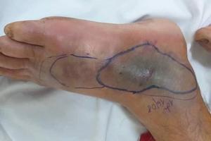 Hà Tĩnh: Rắn độc tấn công, hai người bị hoại tử chân