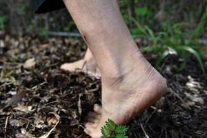 Bộ Y tế khuyến cáo phòng tránh bệnh Whitmore "vi khuẩn ăn thịt người"