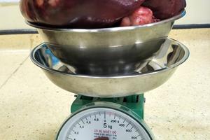 Bệnh viện Xanh Pôn cắt khối u lách khổng lồ nặng 2,3kg