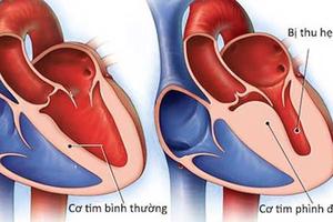 Virus thông thường cũng có thể gây viêm cơ tim