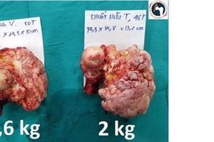 Bác sỹ kinh ngạc với khối u xương đùi hệt cây súp lơ