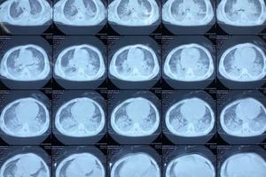 Hải Dương: 3 bệnh nhân sốt cao, viêm phổi đều âm tính với virus Corona