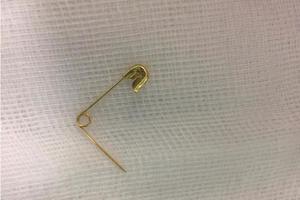 Bé gái 4 tuổi nuốt chiếc kim băng đầu nhọn hoắt vào thực quản