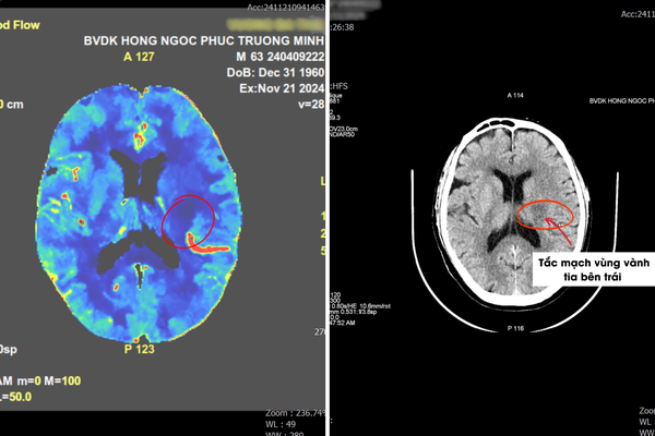 Phát hiện đột quỵ sớm chỉ vài phút nhờ chụp CT 2560 lát cắt, nữ bệnh nhân thoát liệt nửa người
