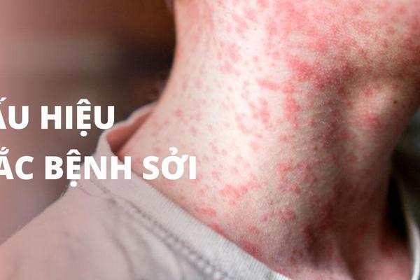 Nghệ An có khoảng 1.100 ca sốt phát ban nghi sởi