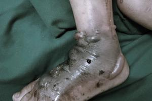 Nhiễm trùng, hoại tử do tự ý sử dụng lá cây, thuốc nam đắp vết thương