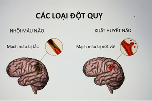 Đột qụy não – báo động đỏ