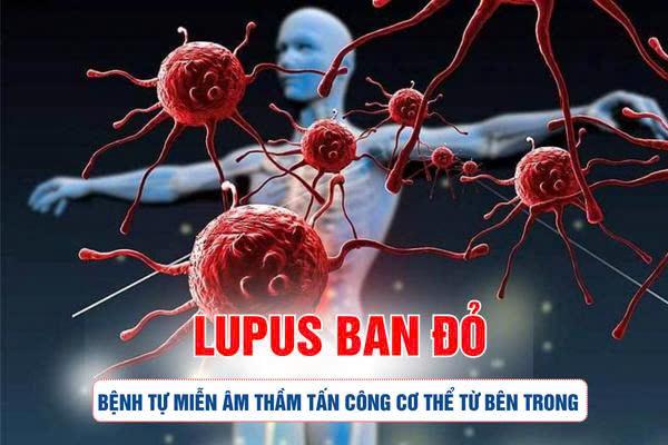 Lupus ban đỏ, bệnh tự miễn âm thầm tấn công cơ thể từ bên trong