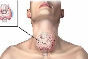 5 cách cải thiện bướu cổ lành tính an toàn và hiệu quả