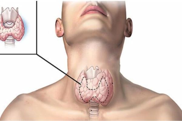 5 cách cải thiện bướu cổ lành tính an toàn và hiệu quả