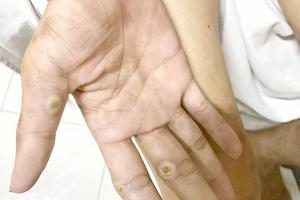 Đồng Nai: Siết chặt kiểm soát, truy vết nguồn lây nhằm hạn chế bệnh đậu mùa khỉ lây lan