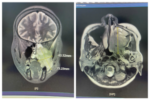 Đau hàm, nghẹt mũi, chảy máu răng - đi khám phát hiện ung thư xoang