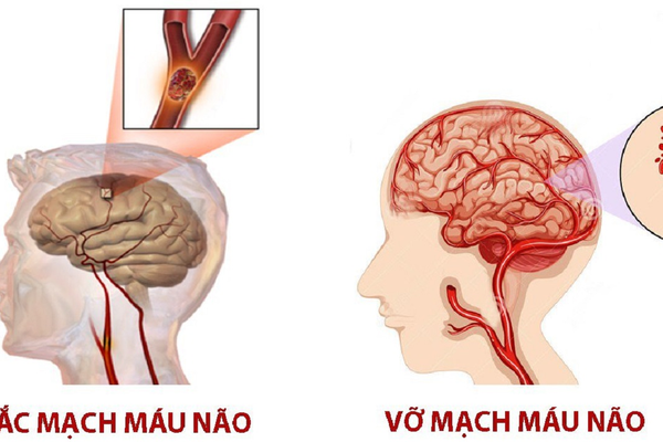 Điều trị tai biến mạch máu não: Ba hướng tiếp cận y khoa hiện nay