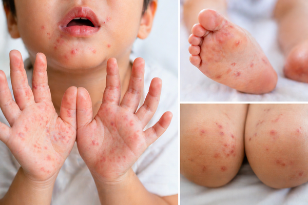 8 ca tử vong, cảnh báo gia tăng ca tay chân miệng diễn biến nặng