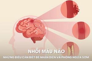 Những điều cần biết để nhận diện và phòng ngừa sớm nhồi máu não