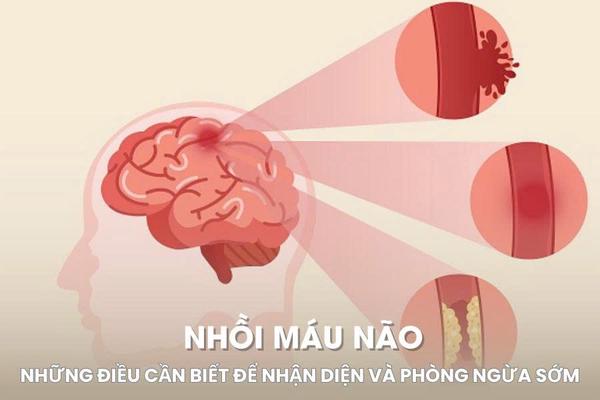 Những điều cần biết để nhận diện và phòng ngừa sớm nhồi máu não