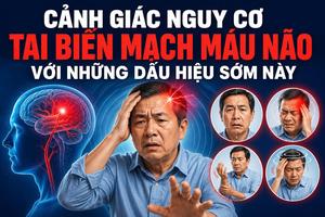 Cảnh giác nguy cơ tai biến mạch máu não với những dấu hiệu sớm này