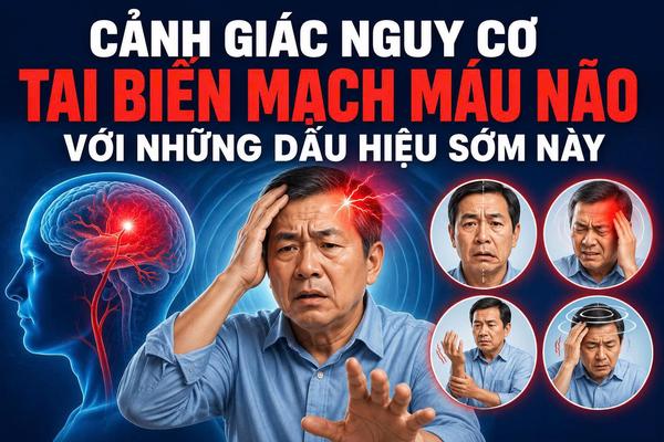 Cảnh giác nguy cơ tai biến mạch máu não với những dấu hiệu sớm này